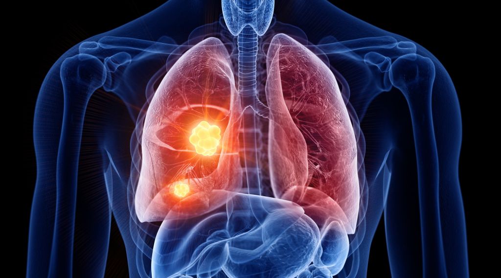 New Study Provides Insight in Identifying, Treating Lung Cancer at
